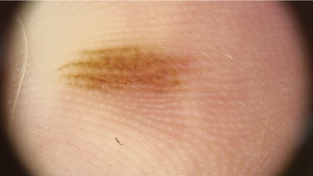 Assessment of melanocytic nevi