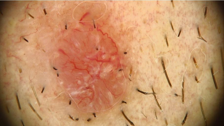 Skin lesion diagnostics for BCC