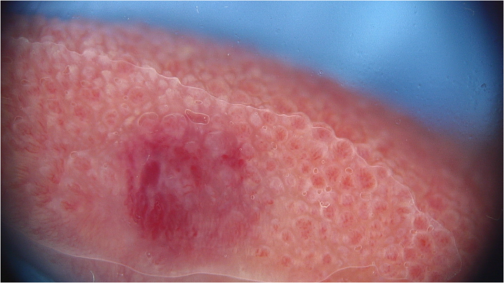 Evaluation of vascular skin lesions