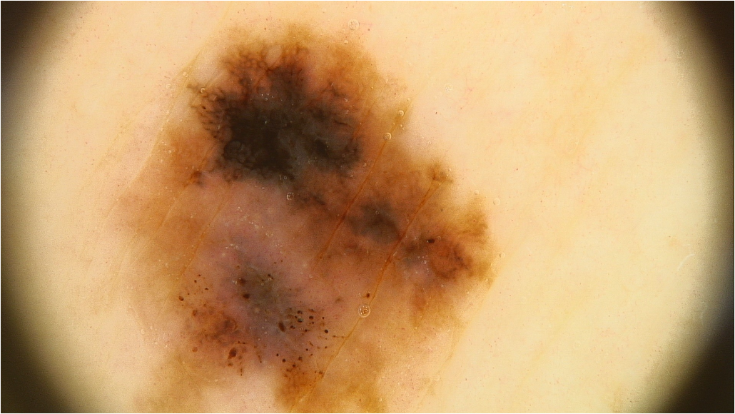 Dermoscopic comparison of pigmented lesions
