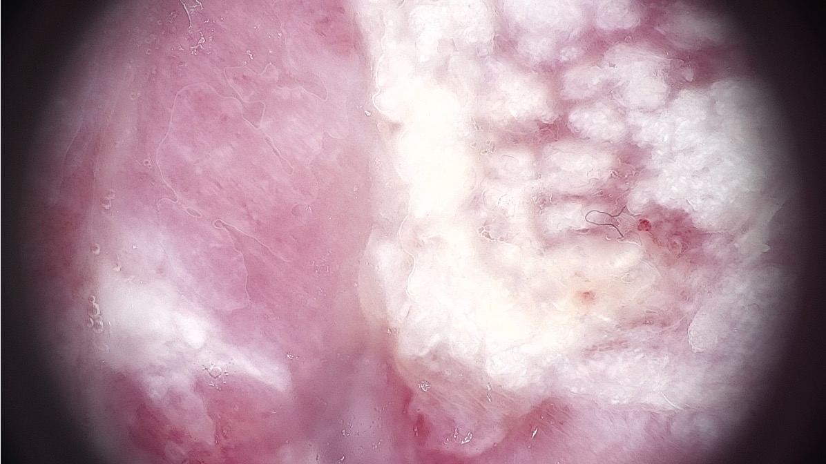 Squamous cell carcinoma assessment