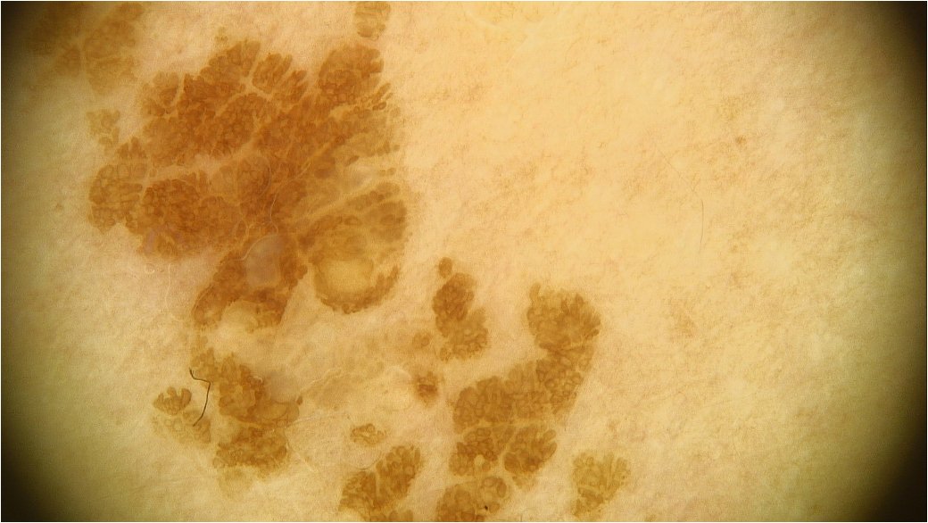 Assessment of superficial skin lesions