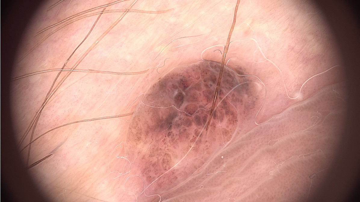 Skin lesion selected for biopsy